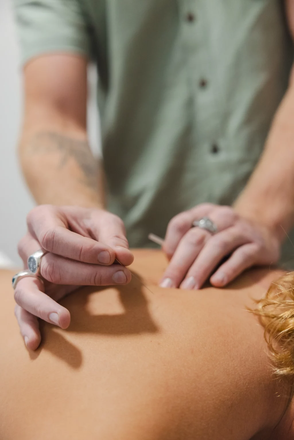 Close-up of myotherapist performing dry needling on patient's back at Nature Of Wellness Gold Coast